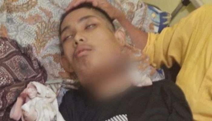 Pemuda Asal Pakenjeng Ini Sebelum Menderita Kanker Lidah Alami Sariawan