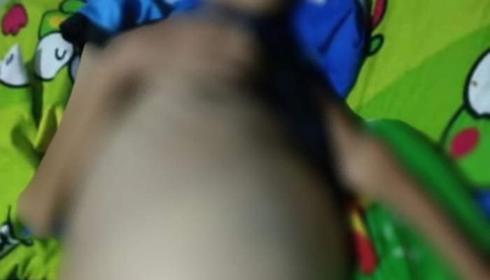 Siswa SD di Pakenjeng Derita Penyakit Busung Lapar, Kadisdik Garut: Sudah Dirujuk ke Rumah Sakit