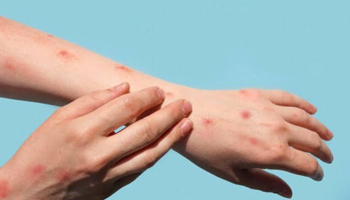 Hati-hati, Cacar Monyet Dapat Menular Antar Manusia Melalui Percikan Ludah