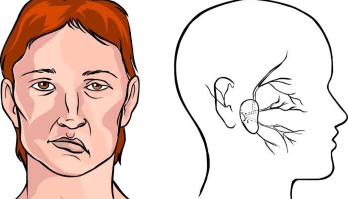 Stroke Harus Ditangani Tak Lebih dari 4,5 Jam Sejak Gejalanya Muncul, Jika Tidak….